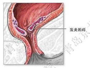 内痔疮最佳的自愈方法